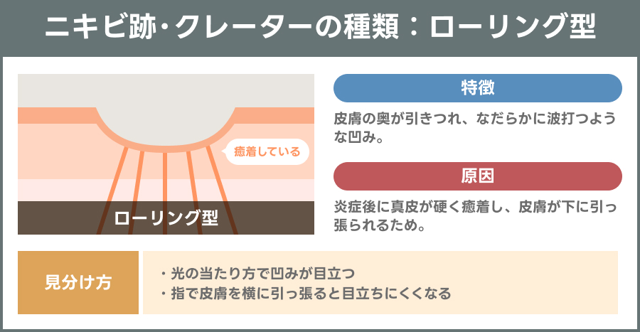 ローリング型のニキビ跡・クレーターを示す説明図｜ライブリークリニック