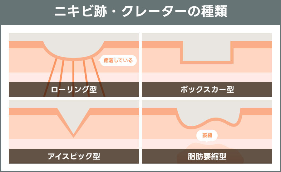 ニキビ跡・クレーターの種類を示す説明図｜ライブリークリニック