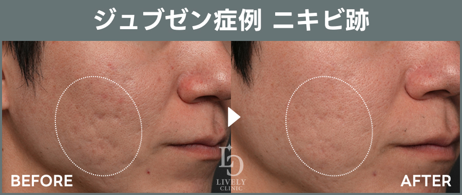 ライブリークリニックのジュブゼン「ニキビ跡治療」の症例画像