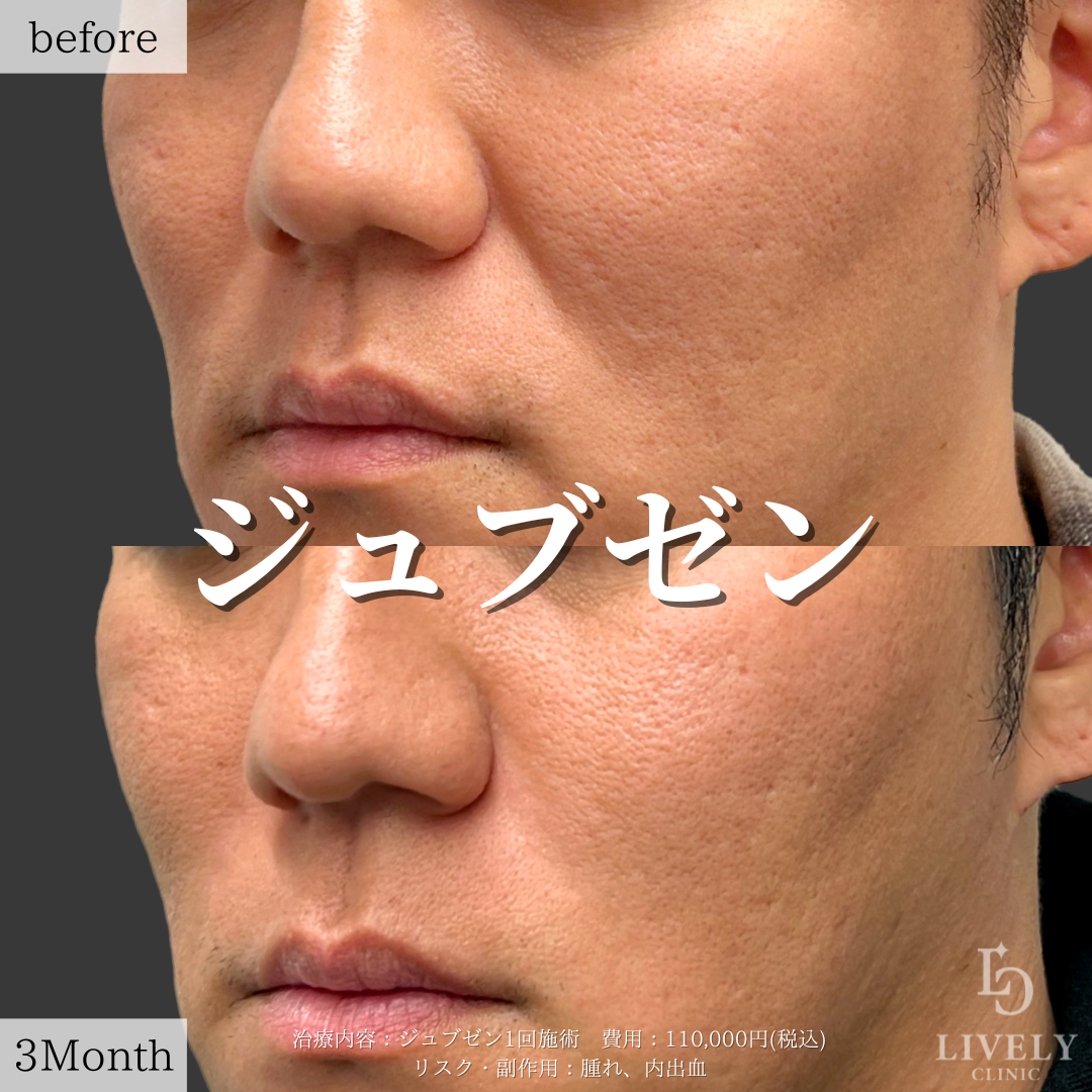 ライブリークリニックのジュブゼン「ほうれい線治療」の症例画像