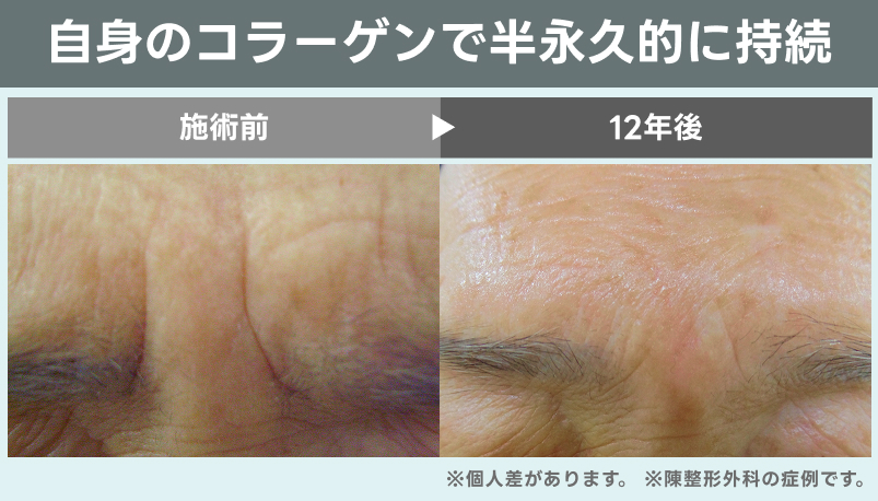 ジュブゼンの半永久的な症例