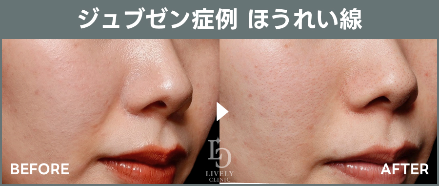 ライブリークリニックのジュブゼン「ほうれい線治療」の症例画像