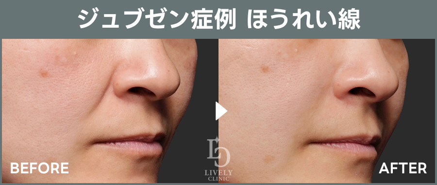 ライブリークリニックのジュブゼン「ほうれい線治療」の症例画像