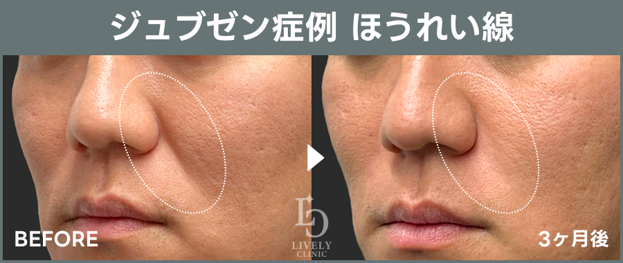 ライブリークリニックのジュブゼン「ほうれい線治療」の経過症例画像