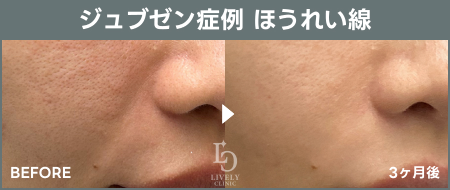 ライブリークリニックのジュブゼン「ほうれい線治療」の症例画像