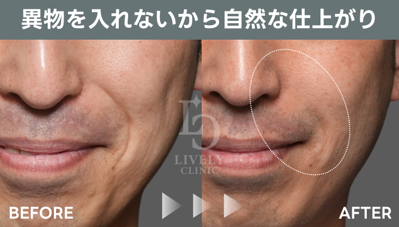 ジュブゼンの自然な仕上がりの症例