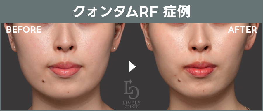 クォンタムRF「たるみ治療治療」の症例画像｜ライブリークリニック