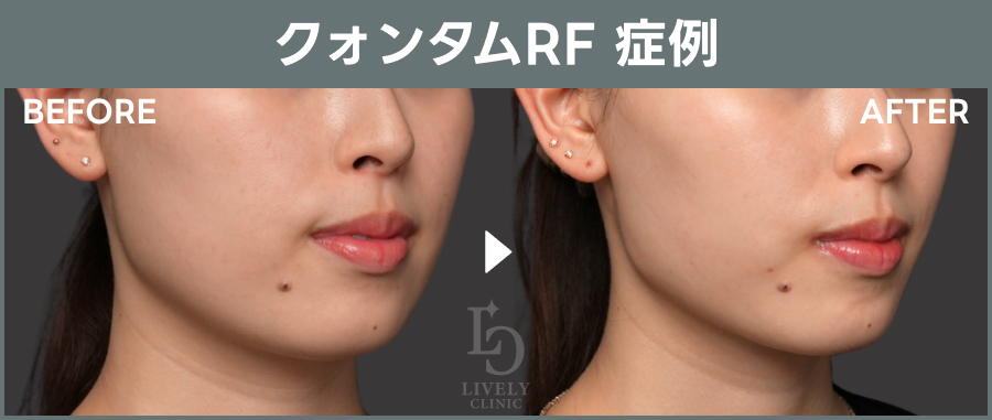 クォンタムRF「たるみ治療治療」の症例画像｜ライブリークリニック