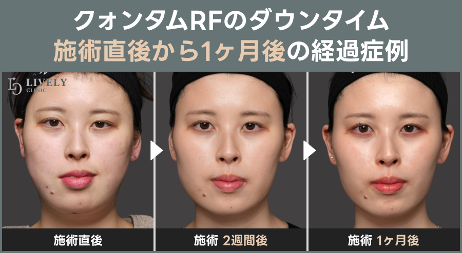 クォンタムRFのダウンタイム・施術直後から1ヶ月後の経過症例｜ライブリークリニック