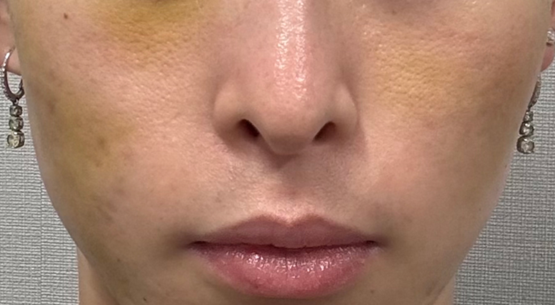 サブシジョンの1〜3日後の様子｜ライブリークリニック