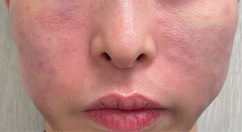 サブシジョンの術後直後の様子｜ライブリークリニック