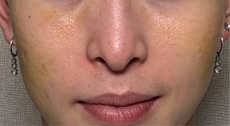 サブシジョンの1週間後の様子｜ライブリークリニック