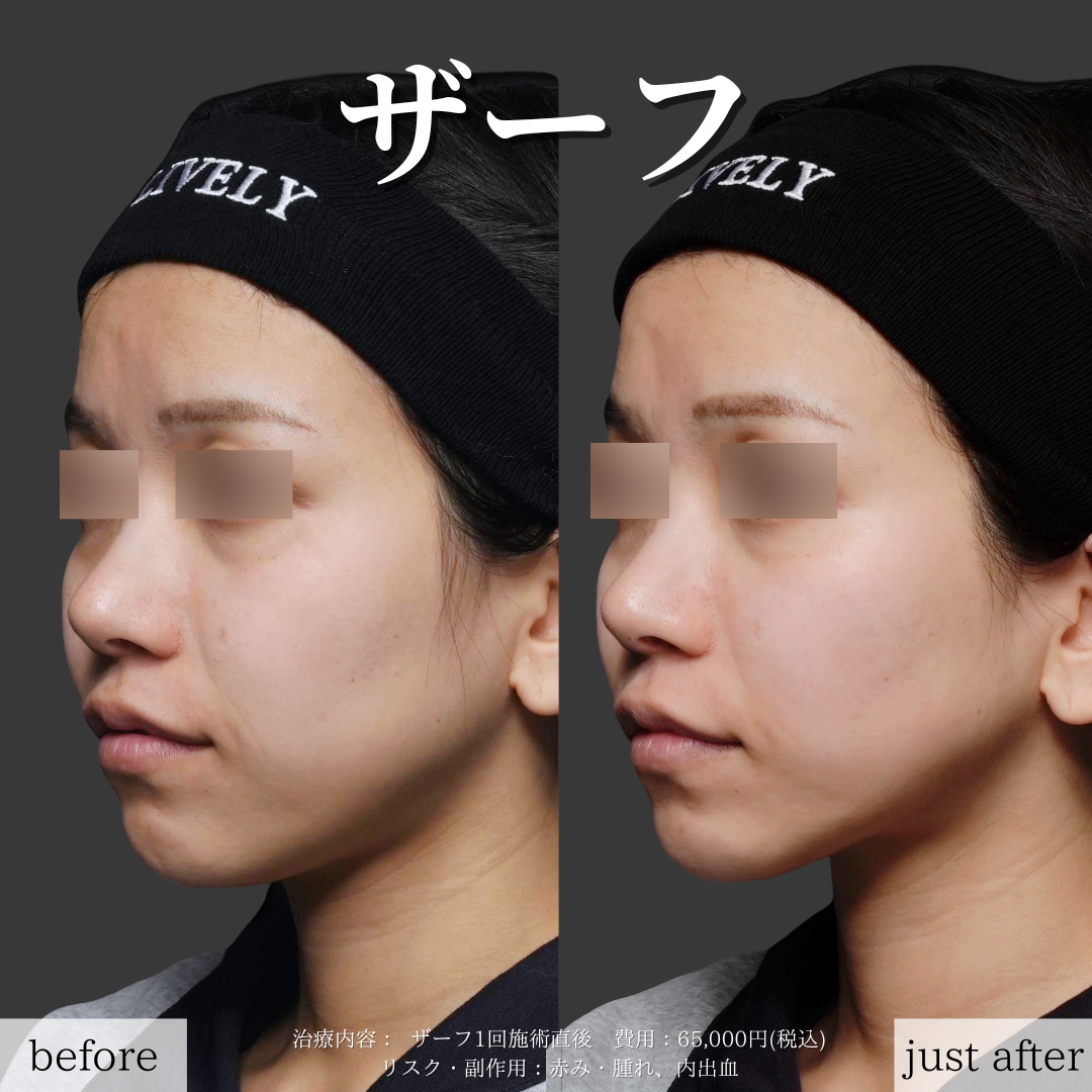 ライブリークリニックのザーフの症例画像