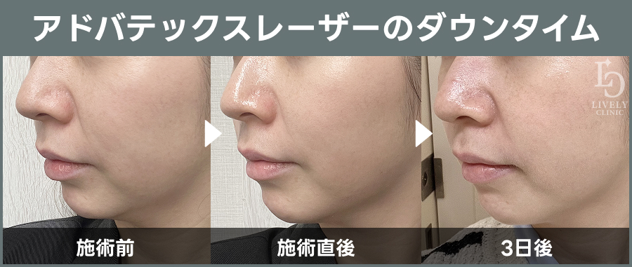アドバテックスレーザーの施術後のダウンタイム｜ライブリークリニック
