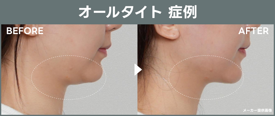 オールタイトの症例｜ライブリークリニック