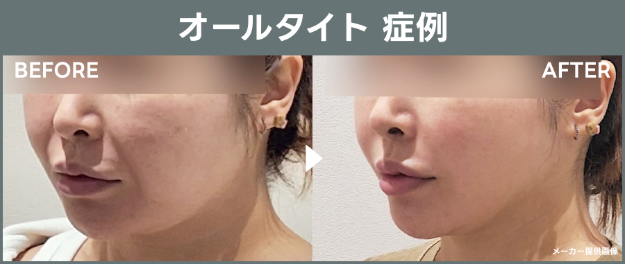 オールタイトの症例｜ライブリークリニック