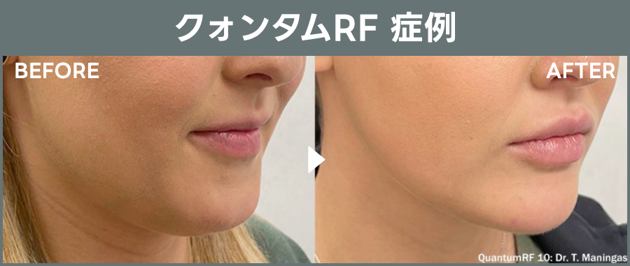 クォンタムRF「たるみ治療治療」の症例画像｜ライブリークリニック