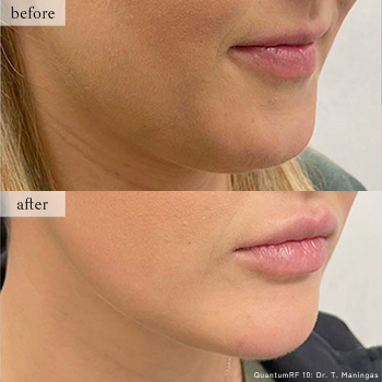 【クォンタムRF】のBefore After写真｜ライブリークリニック