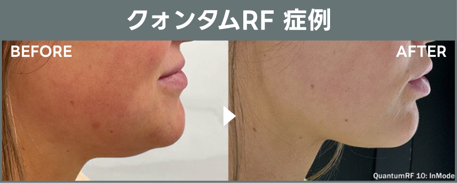 クォンタムRF「たるみ治療治療」の症例画像｜ライブリークリニック