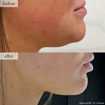 【クォンタムRF】のBefore After写真｜ライブリークリニック