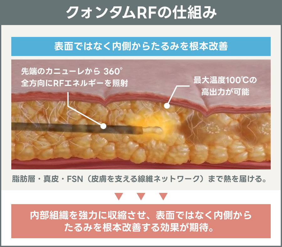 クォンタムRFの仕組みを示す説明図｜ライブリークリニック