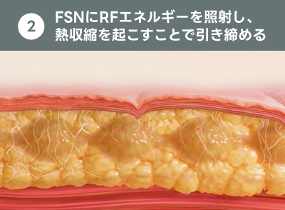クォンタムRFの仕組み｜ライブリークリニック