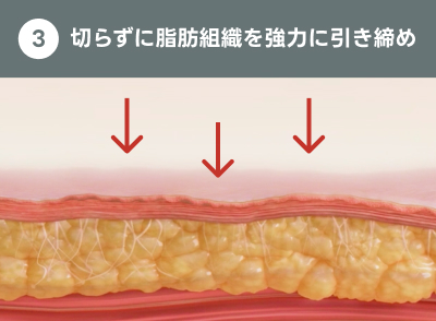 クォンタムRFの仕組み｜ライブリークリニック