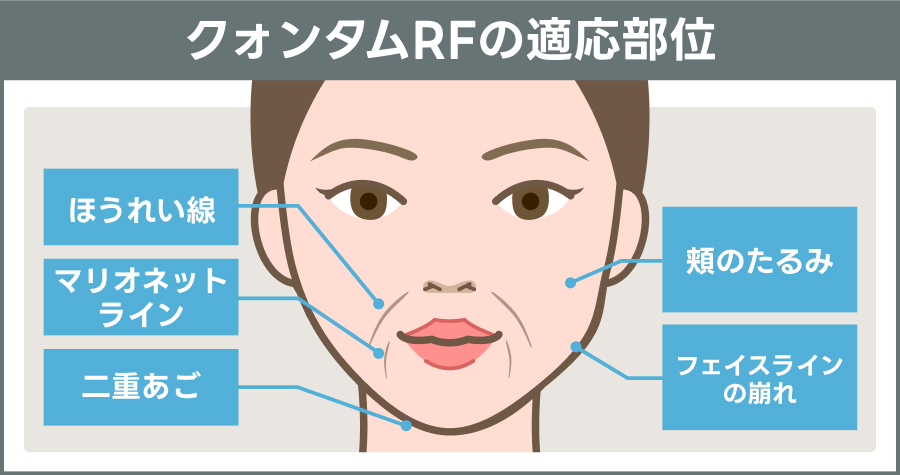 クォンタムRFの適応部位を表す説明図｜ライブリークリニック