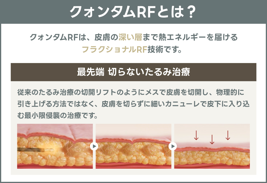 クォンタムRFについての説明図｜ライブリークリニック