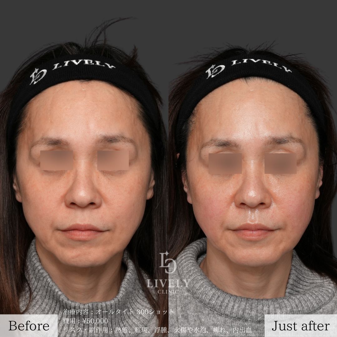 ライブリークリニックのオールタイト「たるみ治療治療」の症例画像