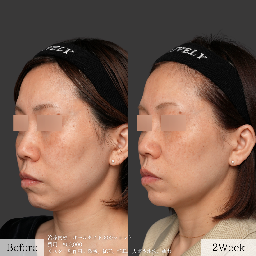 ライブリークリニックのオールタイト「たるみ治療」の症例画像