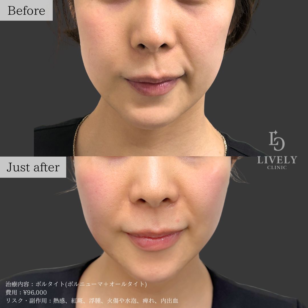 ライブリークリニックのオールタイト「たるみ治療治療」の症例画像