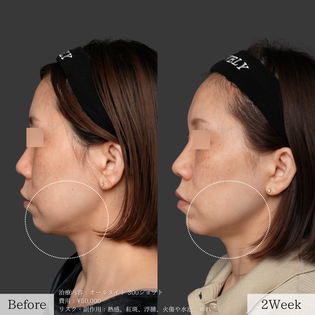 ライブリークリニックのオールタイト「たるみ治療」の症例画像