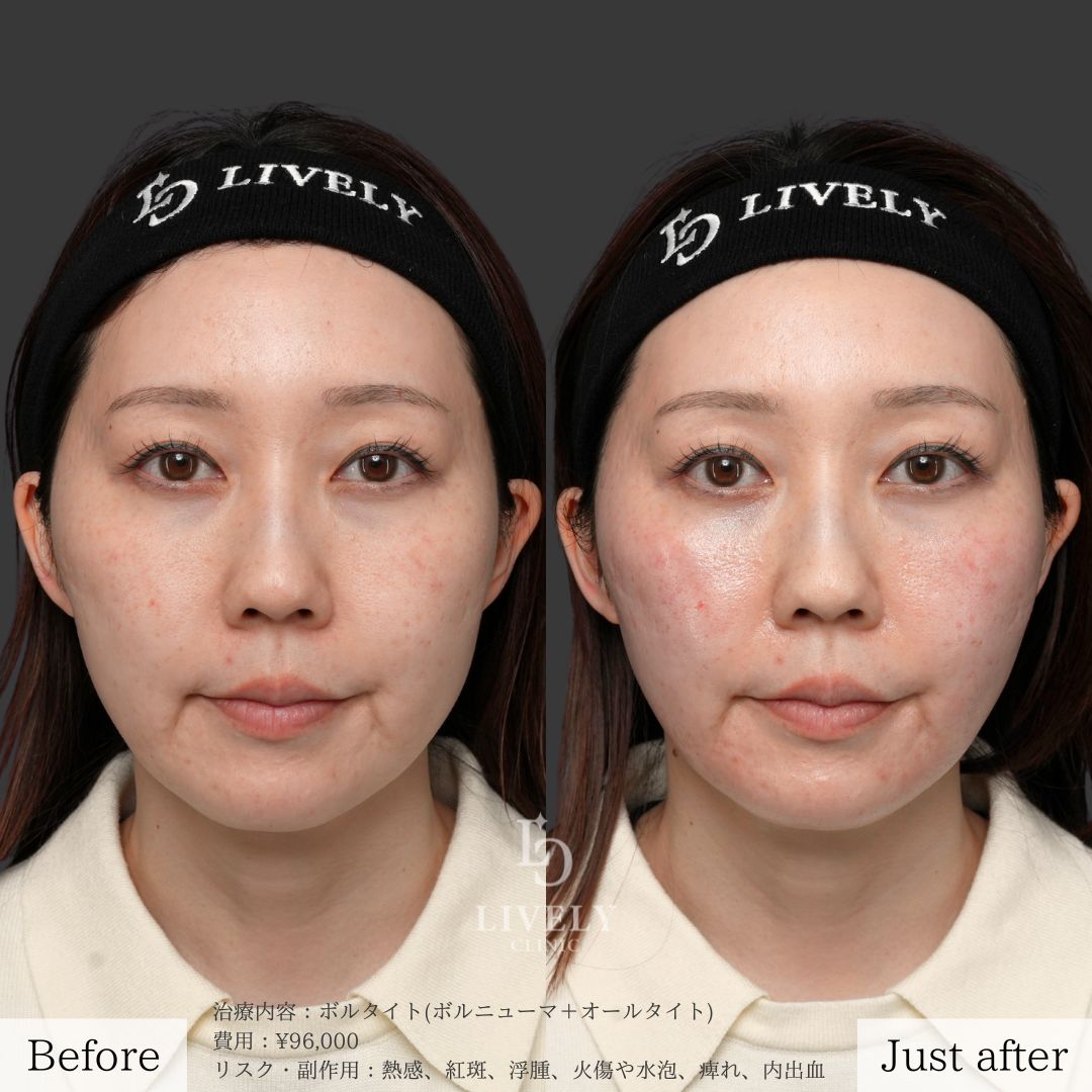 ライブリークリニックのオールタイト「たるみ治療治療」の症例画像