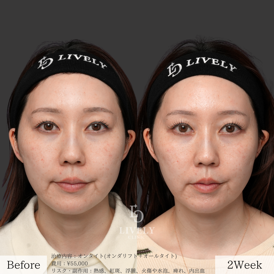 ライブリークリニックのオールタイト「たるみ治療治療」の症例画像