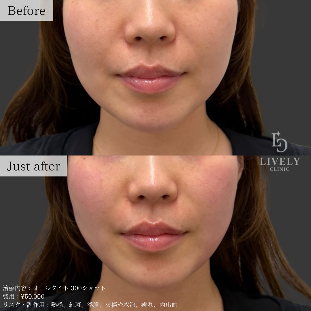 ライブリークリニックのオールタイト「たるみ治療治療」の症例画像