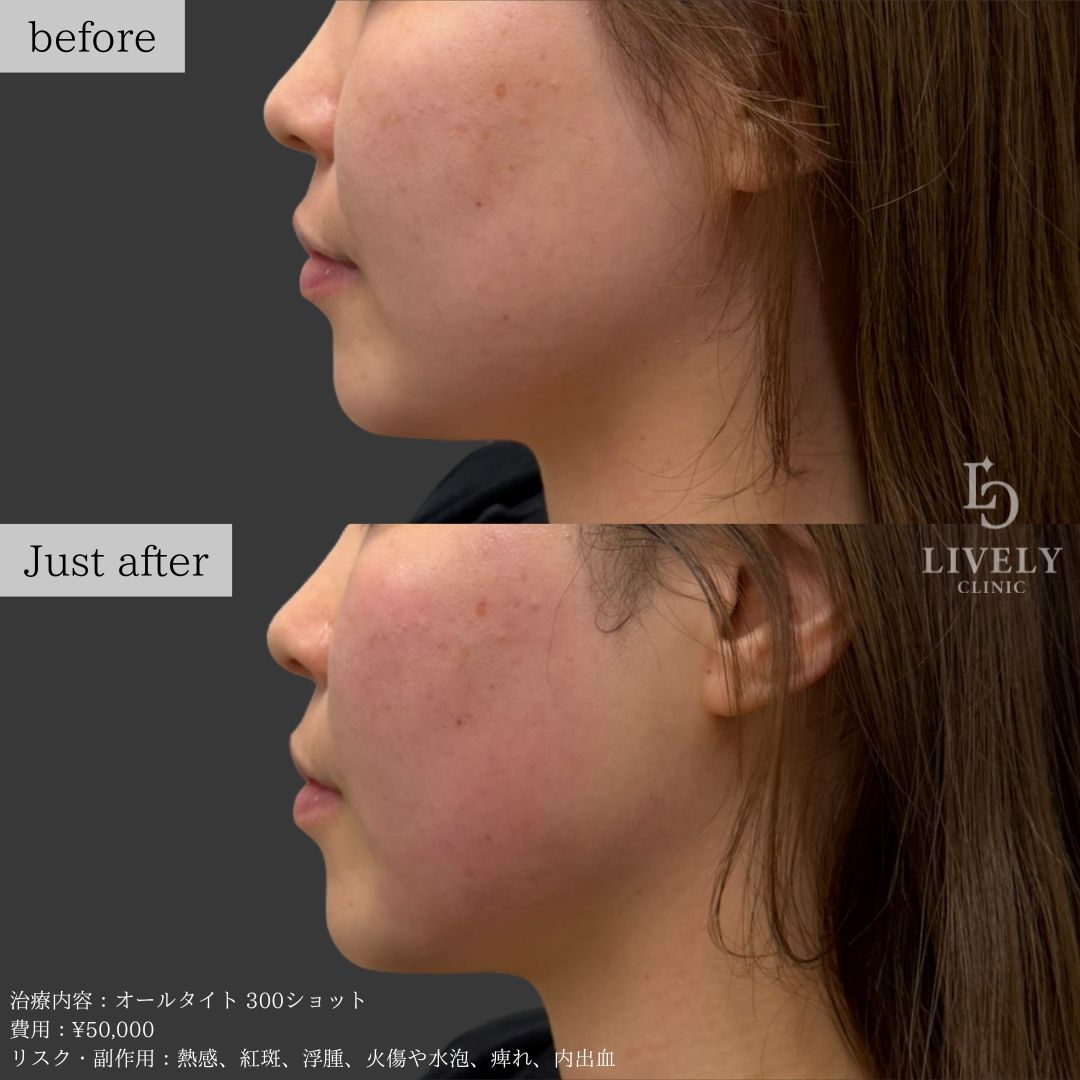 ライブリークリニックのオールタイト「たるみ治療治療」の症例画像