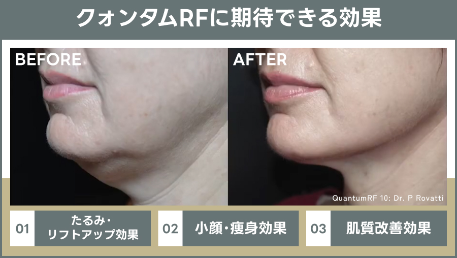 クォンタムRF「たるみ治療」に期待できる効果の説明図｜ライブリークリニック