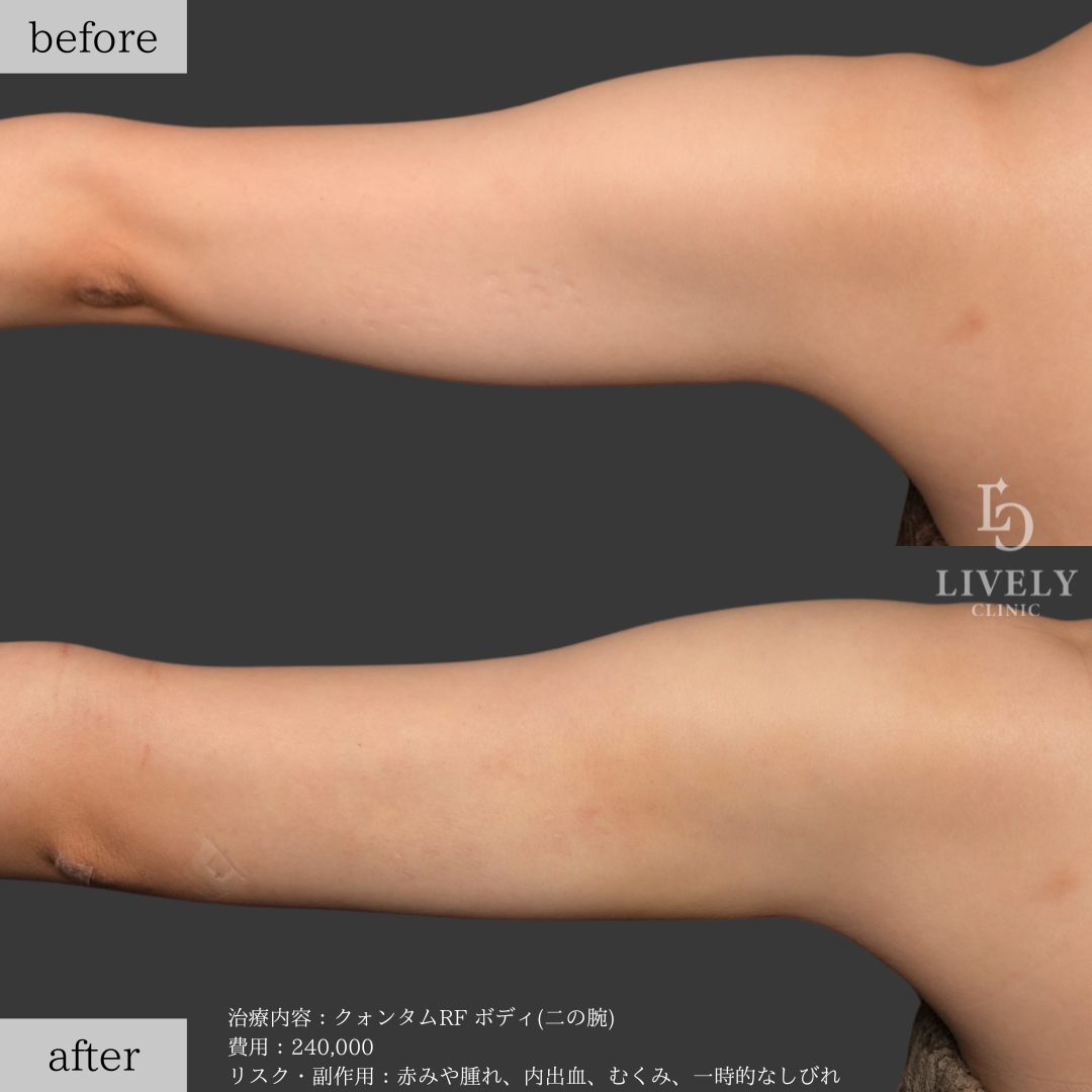 ライブリークリニックのクォンタムRF「二の腕」の症例画像