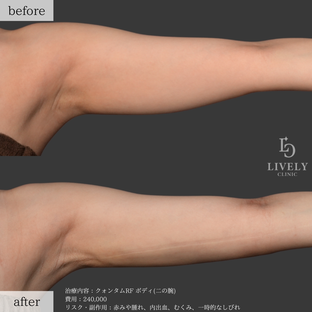 ライブリークリニックのクォンタムRF「二の腕」の症例画像