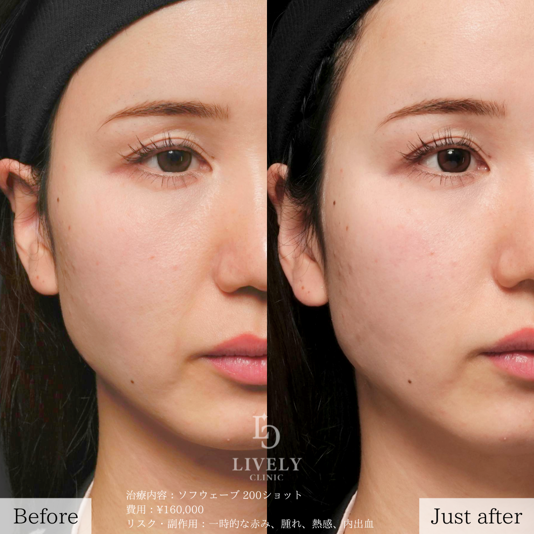 ライブリークリニックのソフウェーブ「たるみ治療」の症例画像