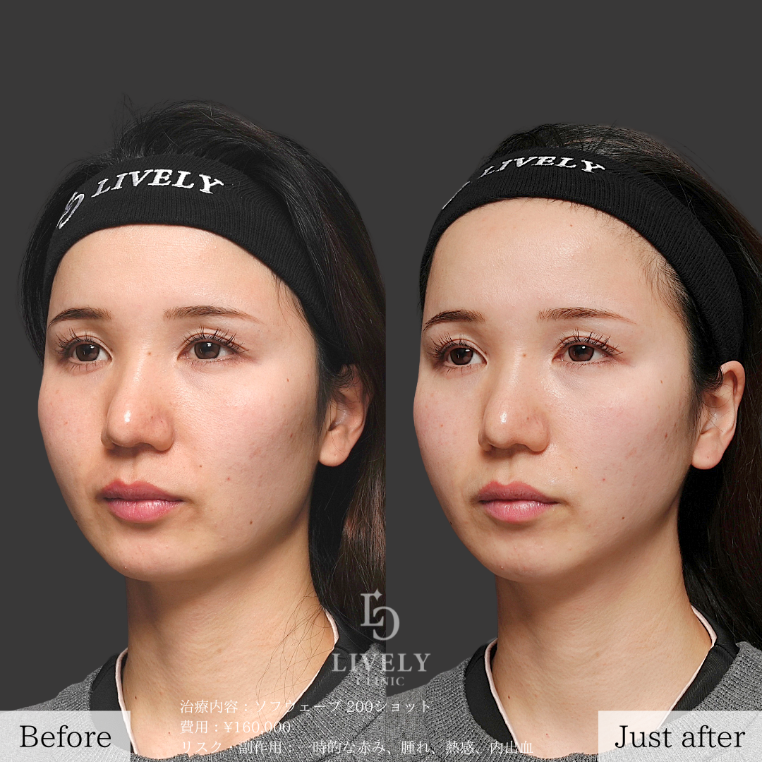 ライブリークリニックのソフウェーブ「たるみ治療」の症例画像