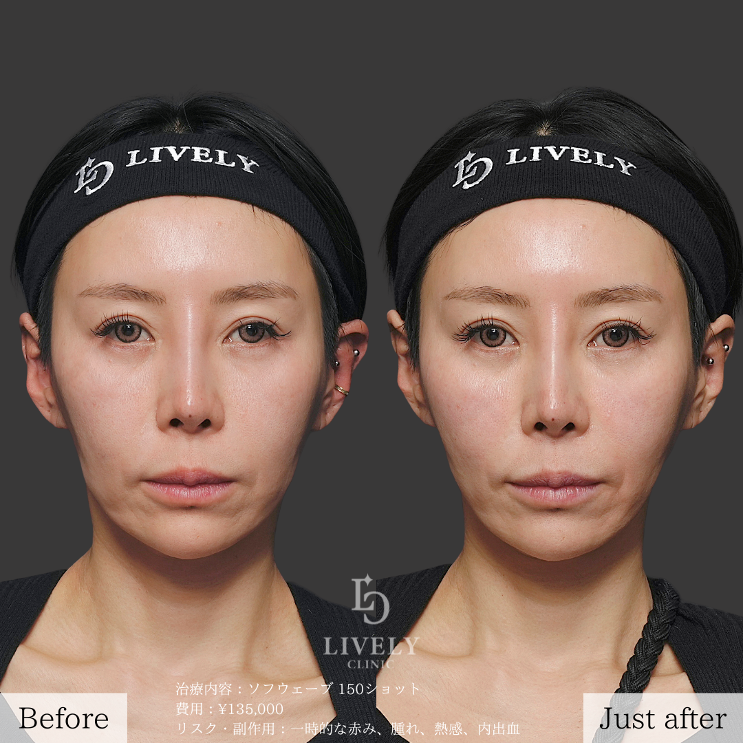 ライブリークリニックのソフウェーブ「たるみ治療」の症例画像
