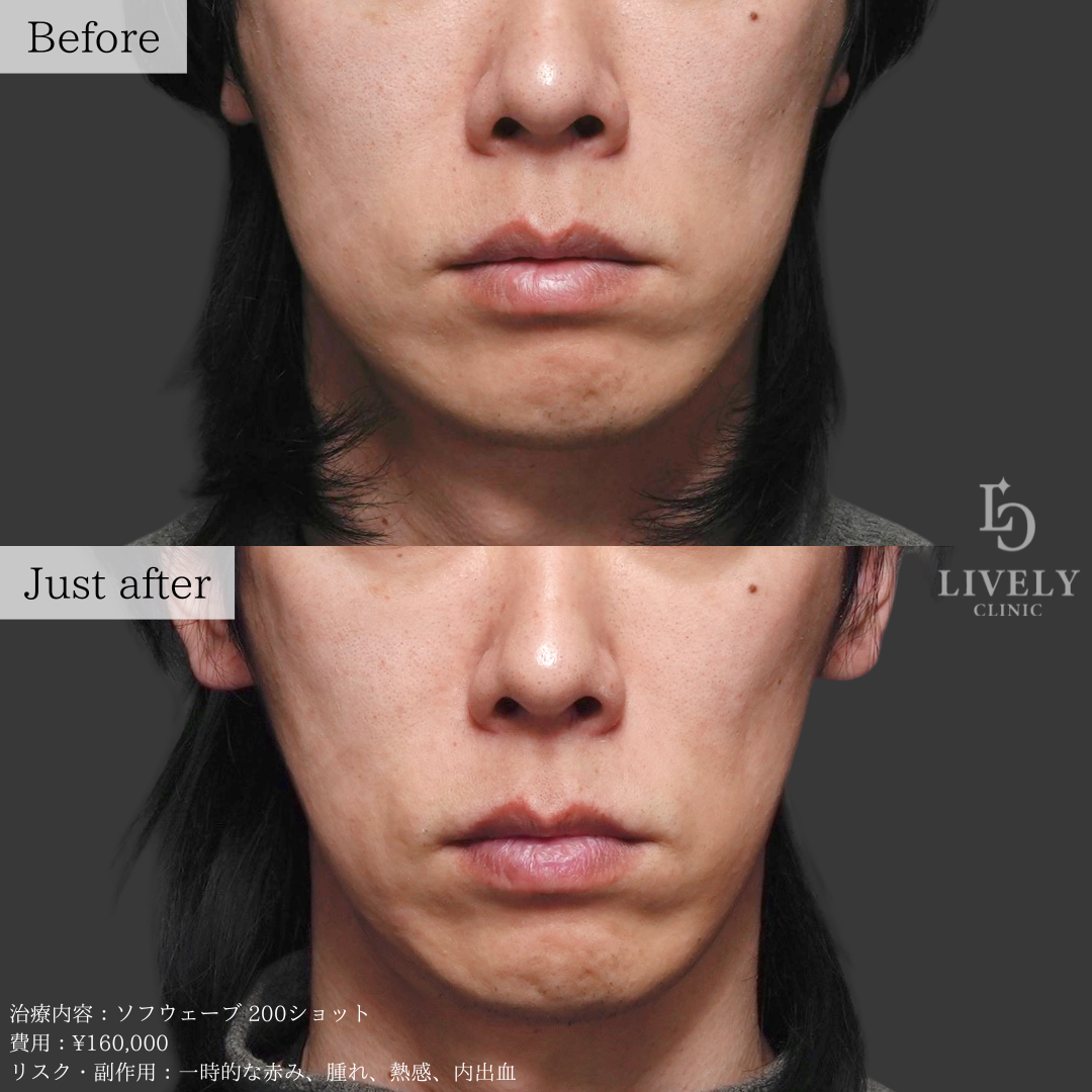ライブリークリニックのソフウェーブ「たるみ治療」の症例画像