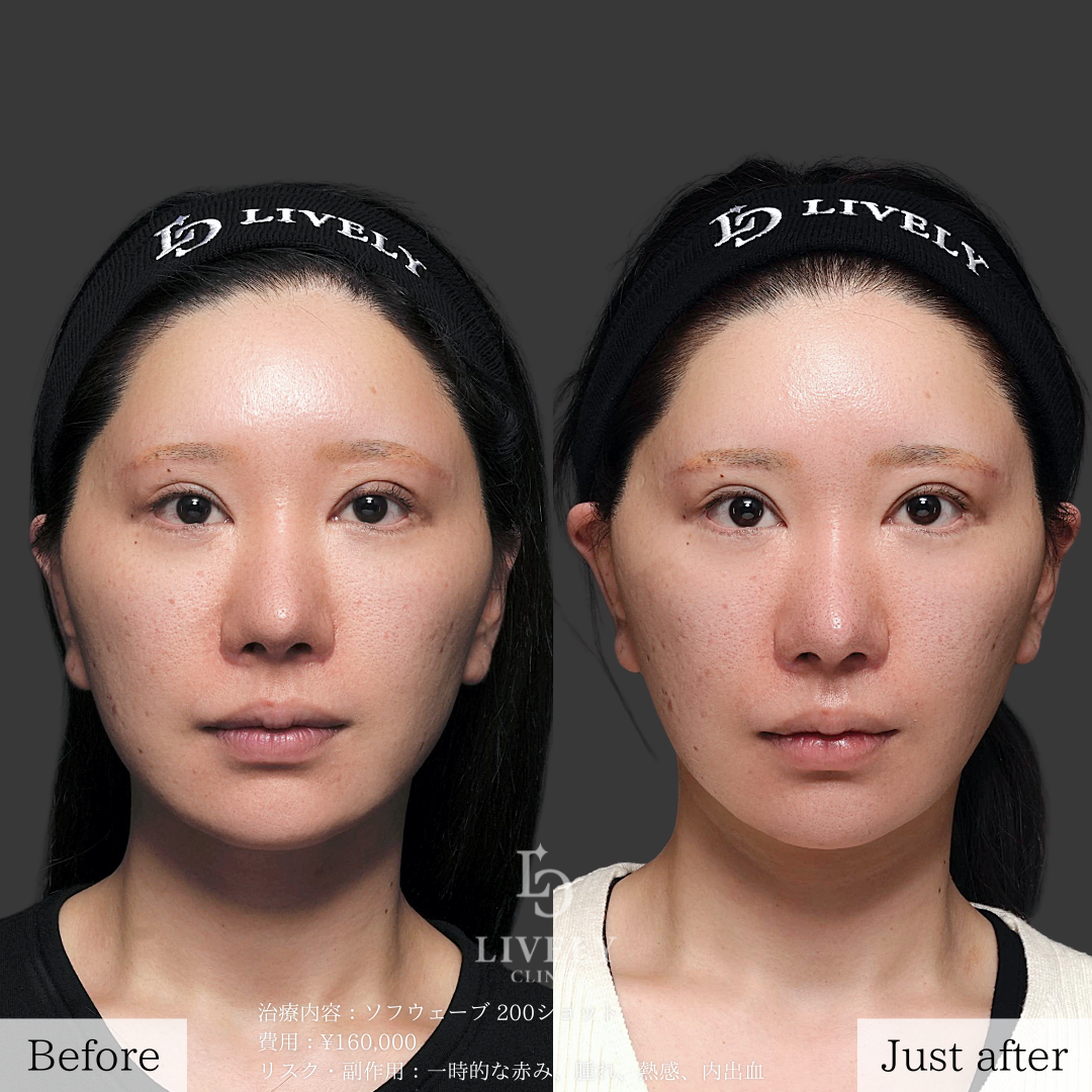 ライブリークリニックのソフウェーブ「たるみ治療」の症例画像