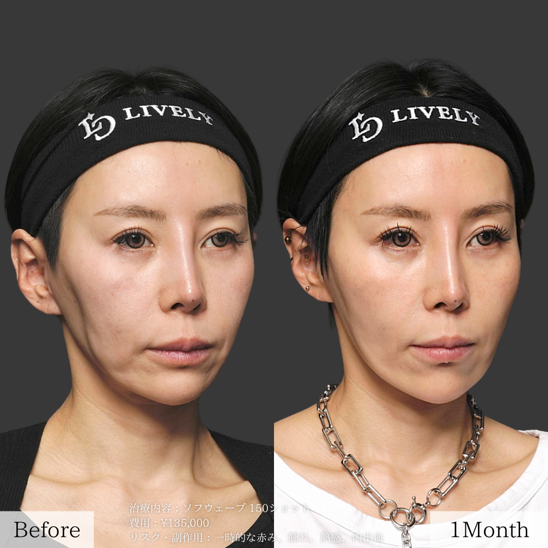 ライブリークリニックのソフウェーブ「たるみ治療」の症例画像