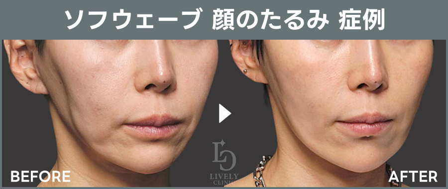 ソフウェーブの顔のたるみの症例｜ライブリークリニック