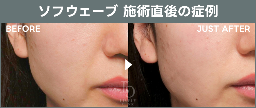 ソフウェーブの施術直後の症例｜ライブリークリニック