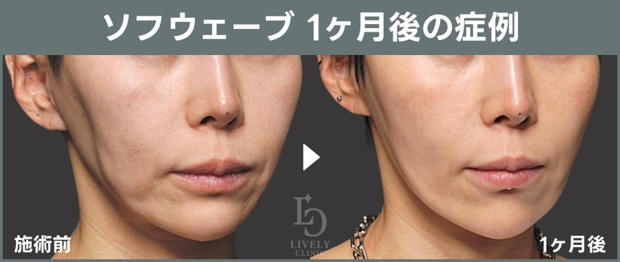 ソフウェーブの1ヶ月後の症例｜ライブリークリニック