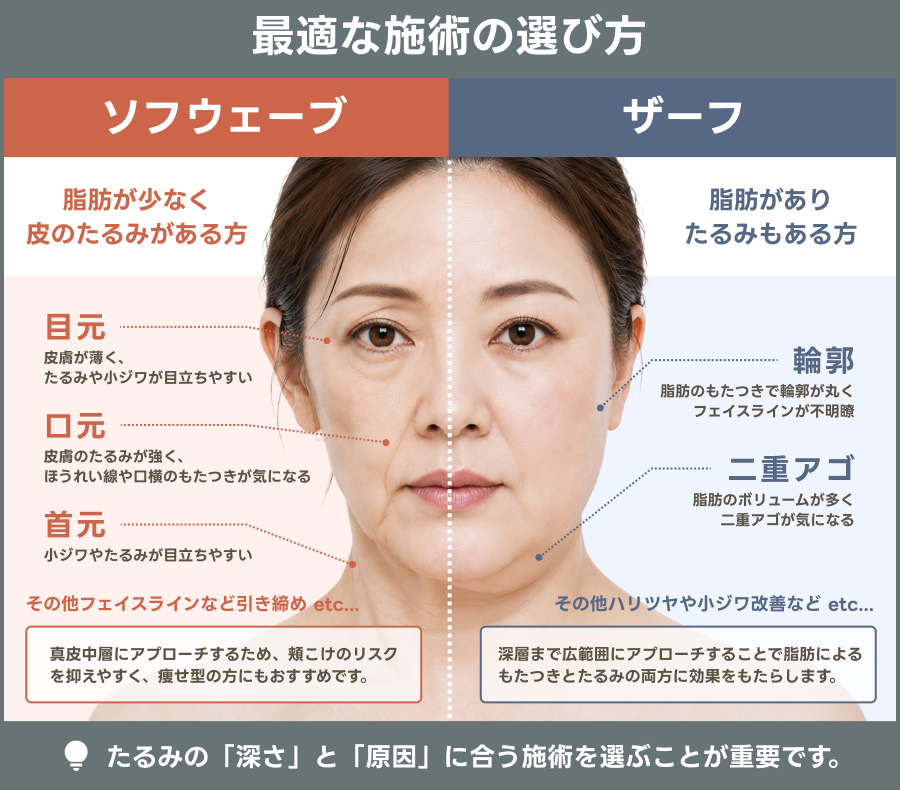 ソフウェーブとザーフの施術の選び方比較表｜ライブリークリニック